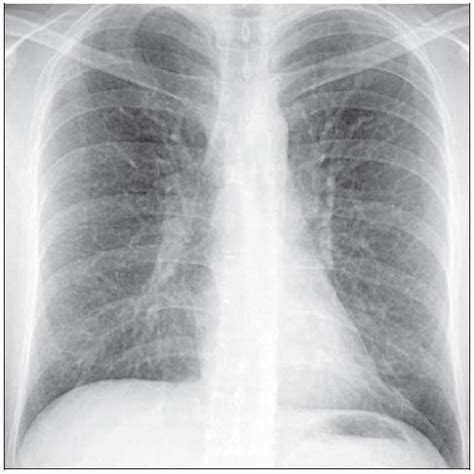 asthma on xray